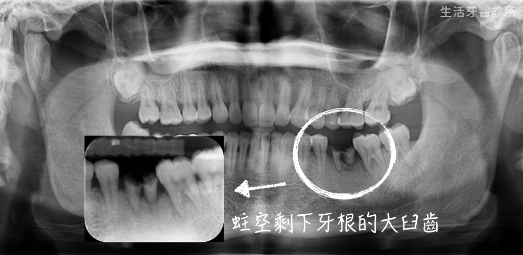 牙齒斷裂+台中植牙假牙牙醫推薦+牙根裂掉