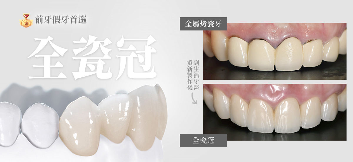 台中全瓷冠牙醫推薦