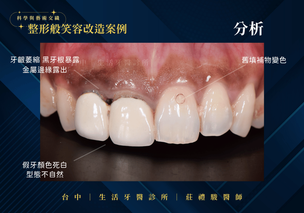 全瓷冠+牙冠增長術案例-台中生活牙醫莊禮駿醫師