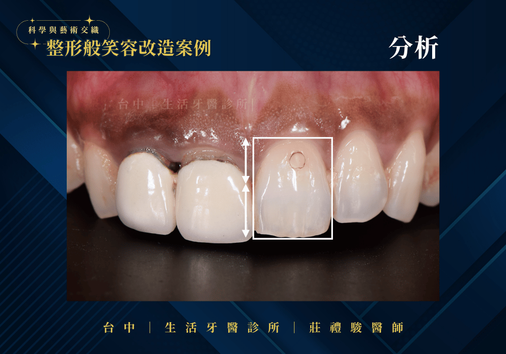 全瓷冠+牙冠增長術案例-台中生活牙醫莊禮駿醫師