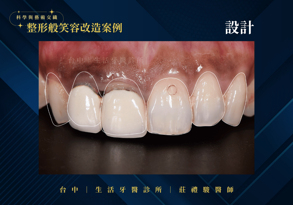 全瓷冠+牙冠增長術案例-台中生活牙醫莊禮駿醫師