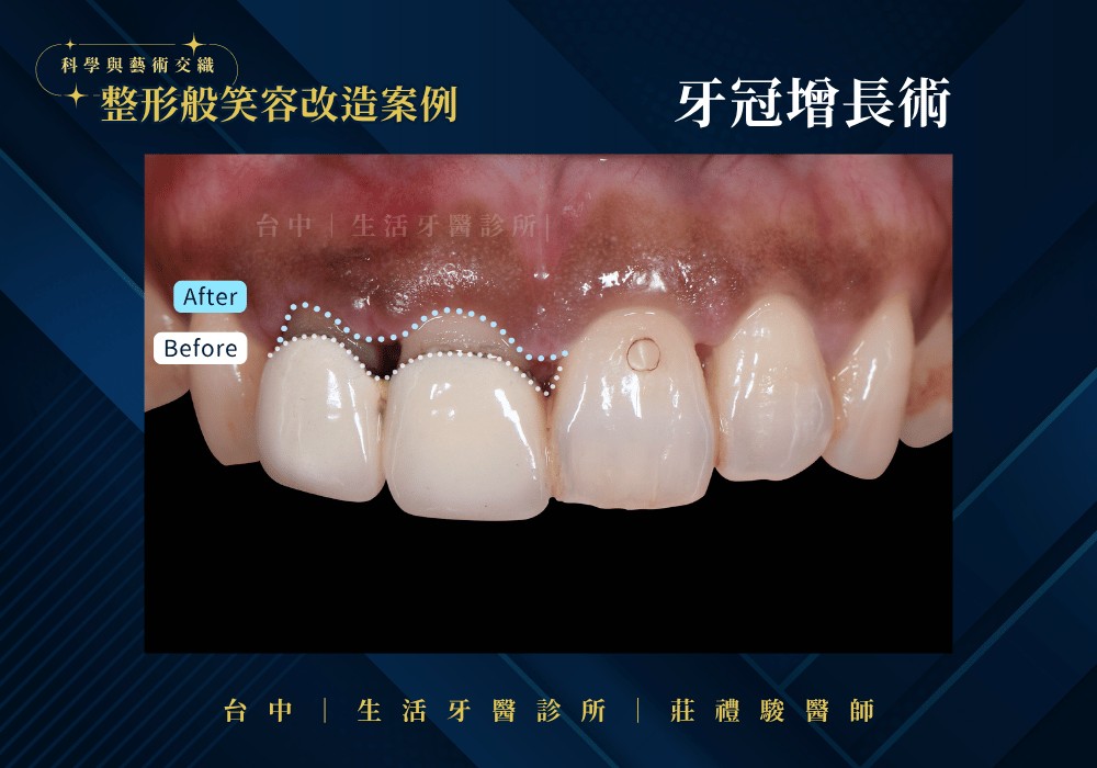 全瓷冠+牙冠增長術案例-台中生活牙醫莊禮駿醫師