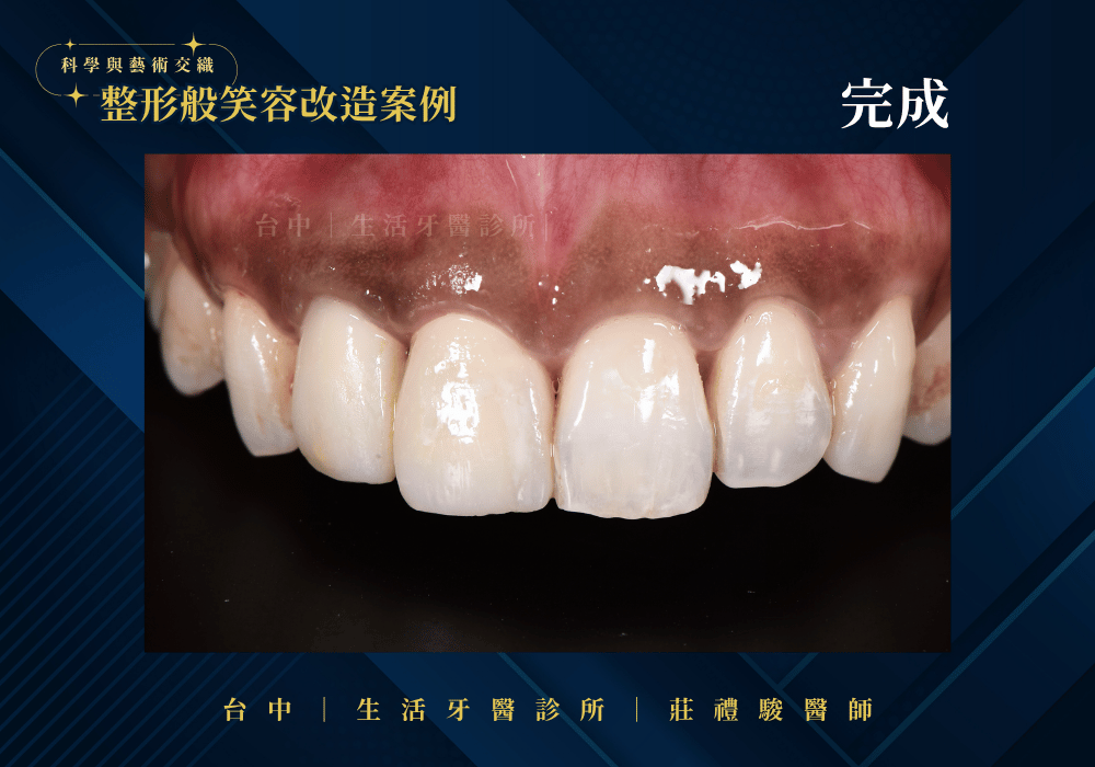 全瓷冠+牙冠增長術案例-台中生活牙醫莊禮駿醫師