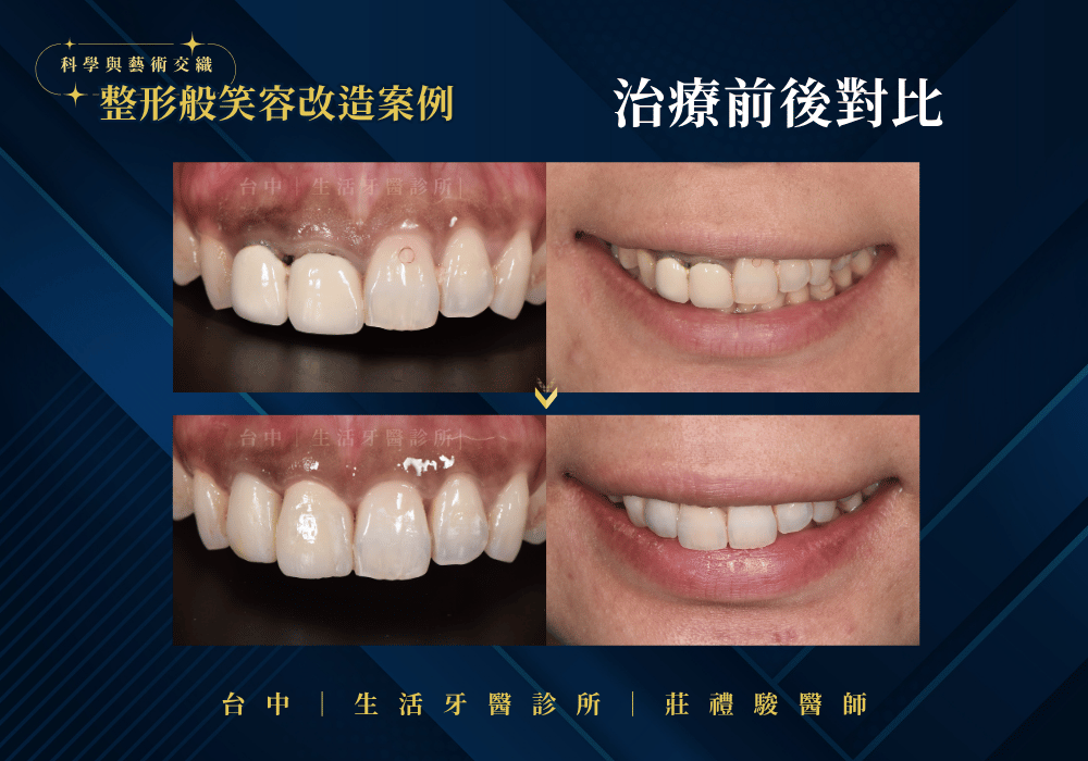 全瓷冠+牙冠增長術案例-台中生活牙醫莊禮駿醫師
