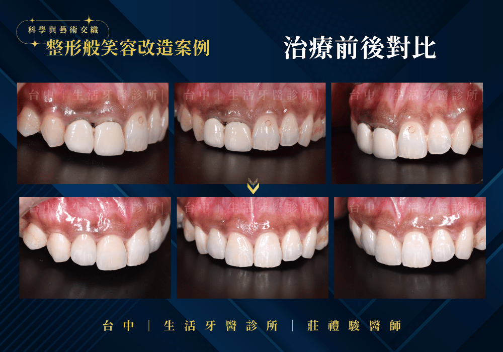 全瓷冠+牙冠增長術案例-台中生活牙醫莊禮駿醫師