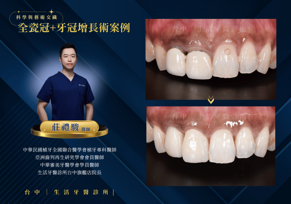 全瓷冠+牙冠增長術案例-台中生活牙醫莊禮駿醫師