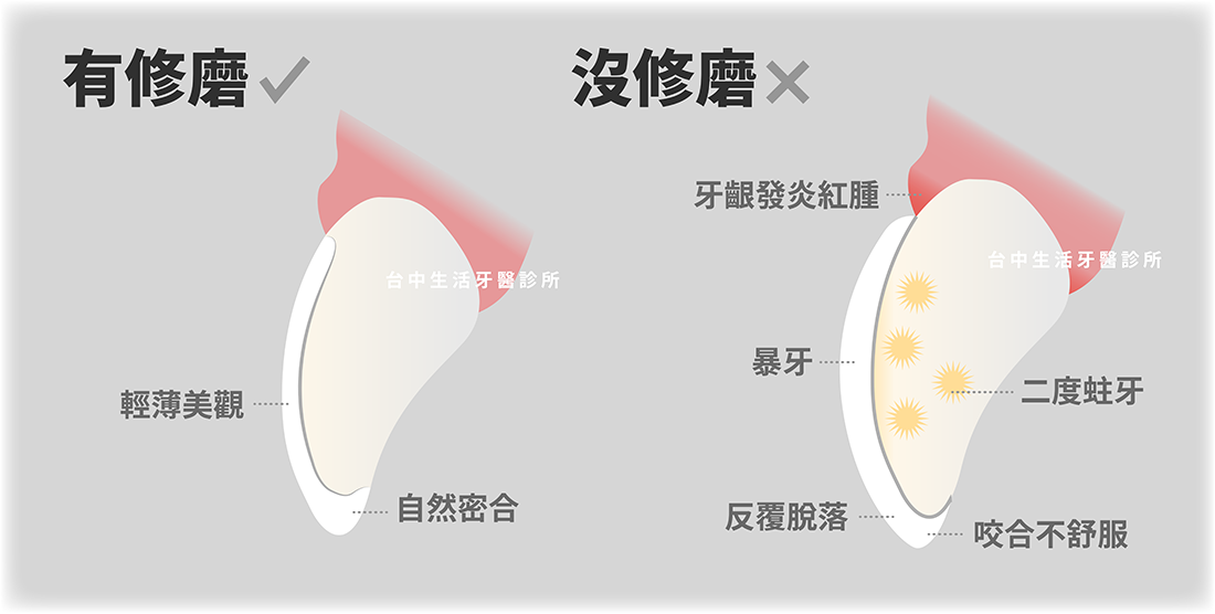 製作陶瓷美齒貼片一定要磨牙齒嗎？台中推薦牙醫來解答