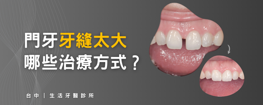 門牙有縫怎麼辦？牙縫太大有哪些治療方式？台中牙醫推薦生活牙醫