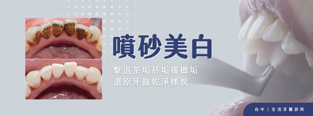 牙齒斷裂+台中假牙牙醫推薦+全瓷冠