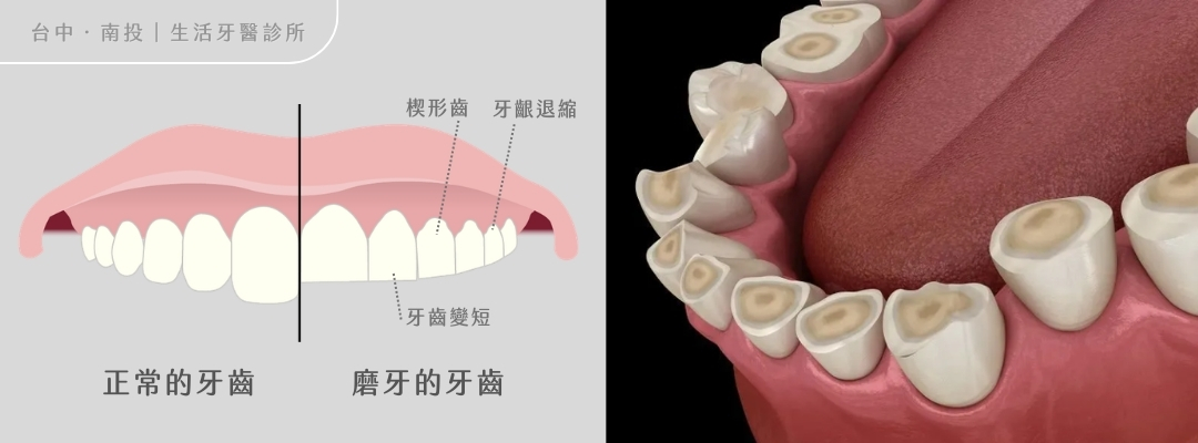 磨牙牙齒酸軟敏感變短+台中牙醫推薦生活牙醫+全瓷冠假牙+陶瓷嵌體