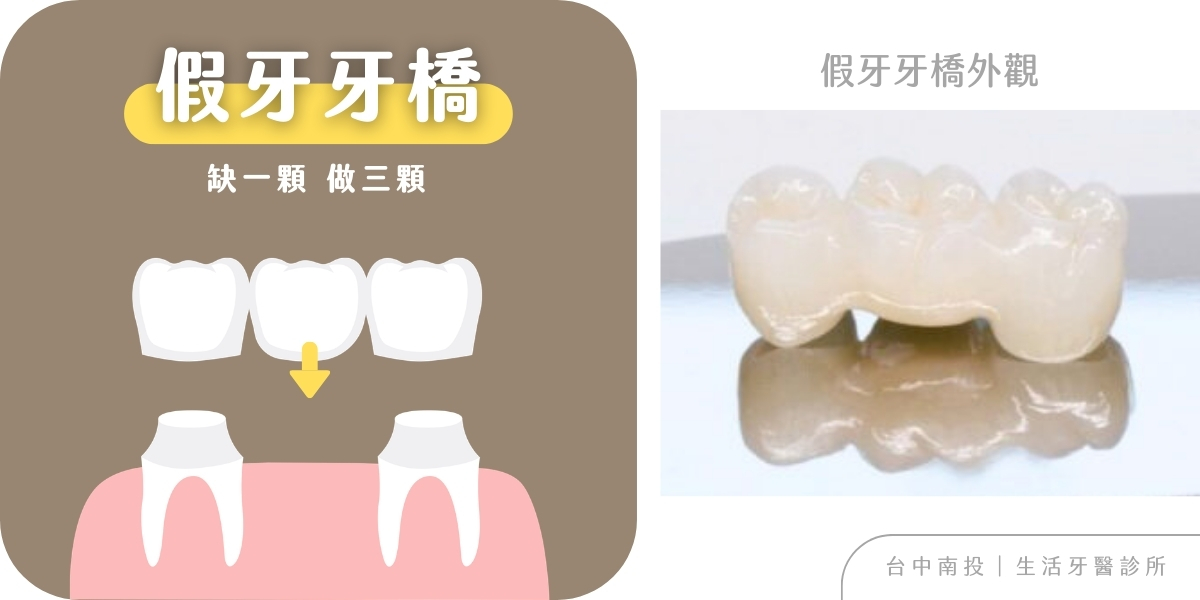 全瓷冠假牙、牙橋、活動假牙完整種類與優缺點分析+台中牙醫推薦生活牙醫