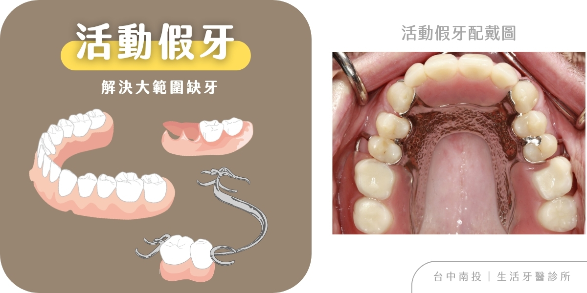 全瓷冠假牙、牙橋、活動假牙完整種類與優缺點分析+台中牙醫推薦生活牙醫