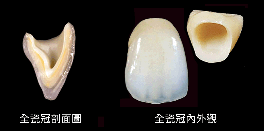 台中全瓷冠專家,南投全瓷冠假牙,生活牙醫假牙保固2年