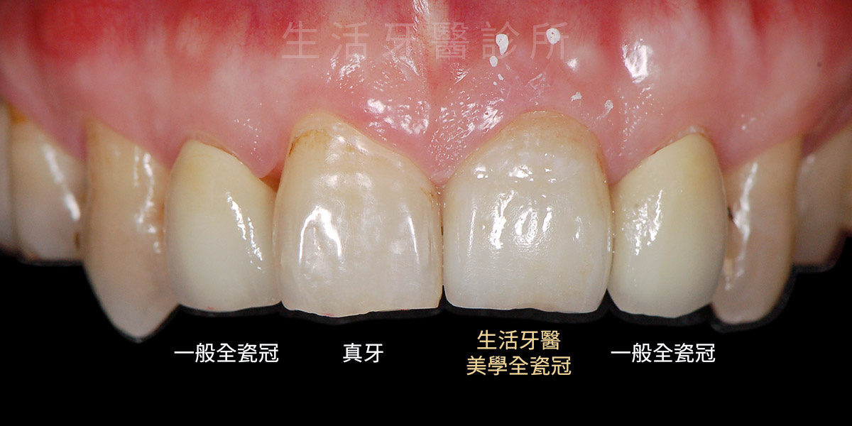 台中全瓷冠專家,南投全瓷冠假牙,生活牙醫假牙保固2年