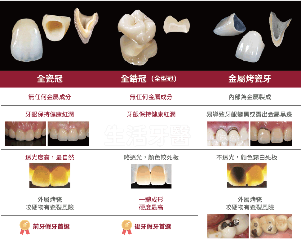 台中全瓷冠,台中牙醫推薦,台中假牙牙醫推薦,全鋯冠,假牙材質比較