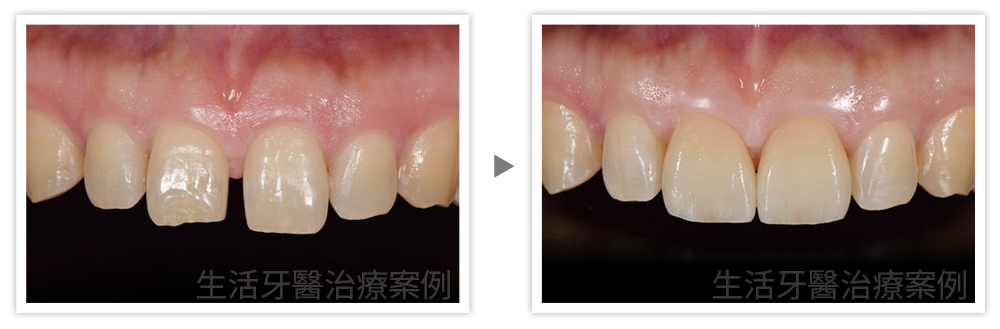 台中全瓷貼片推薦,台中美齒貼片推薦,全瓷美齒貼片價錢價格費用收費台中牙醫