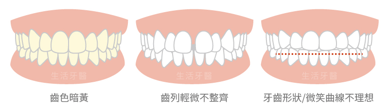 台中全瓷冠,台中牙醫推薦,台中假牙牙醫推薦,全鋯冠,假牙材質比較