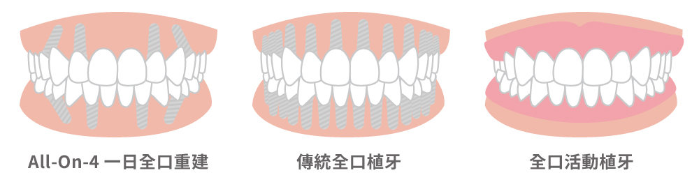 全口重建,台中全口重建,南投全口重建,活動假牙,全口植牙