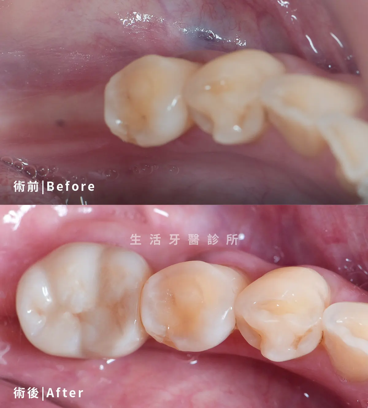 台中生活牙醫朱明輝醫師後牙數位植牙案例