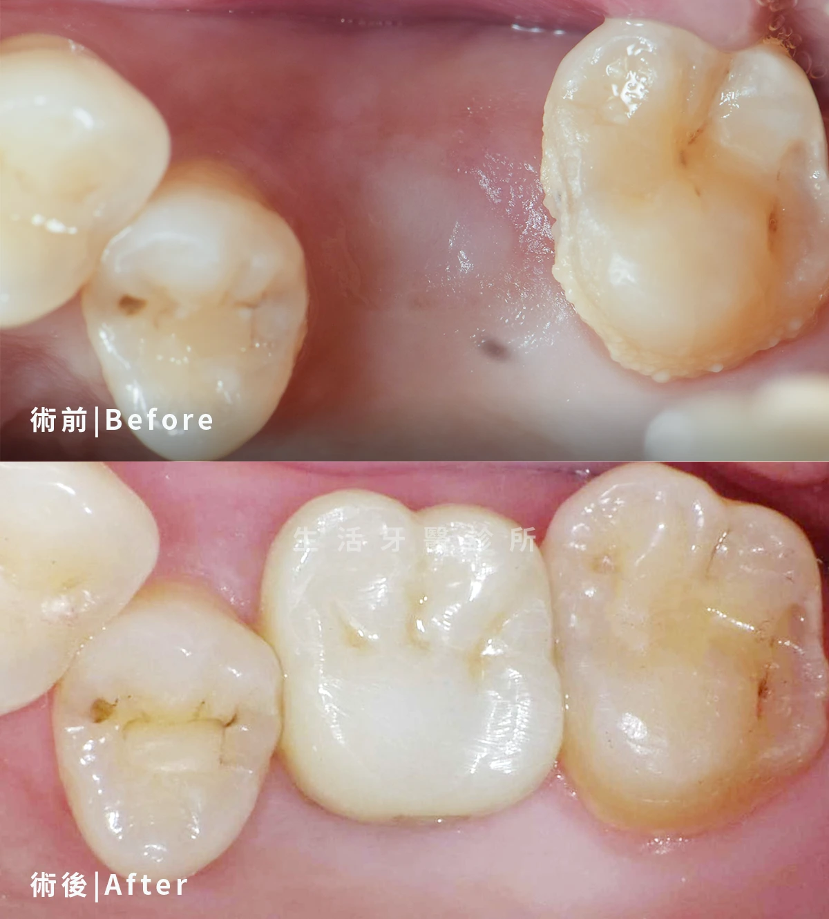 台中南投生活牙醫後牙臼齒單顆數位植牙案例