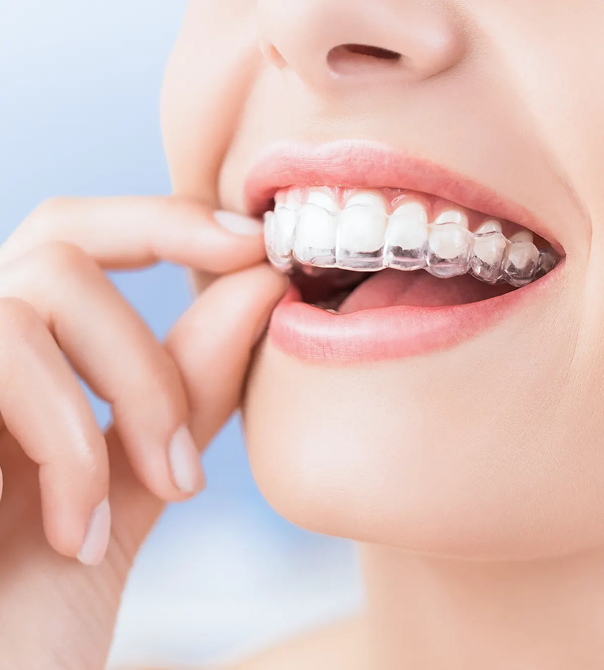 台中南投生活牙醫 Invisalign 隱適美隱形矯正療程