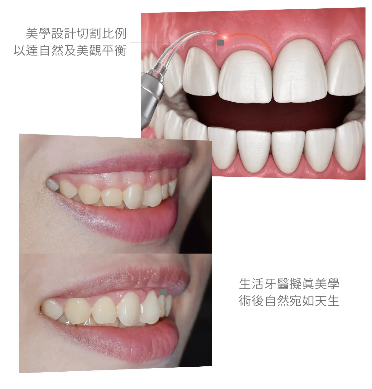 台中南投生活牙醫生活牙醫牙齦整形改善牙齦比例與微笑曲線案例