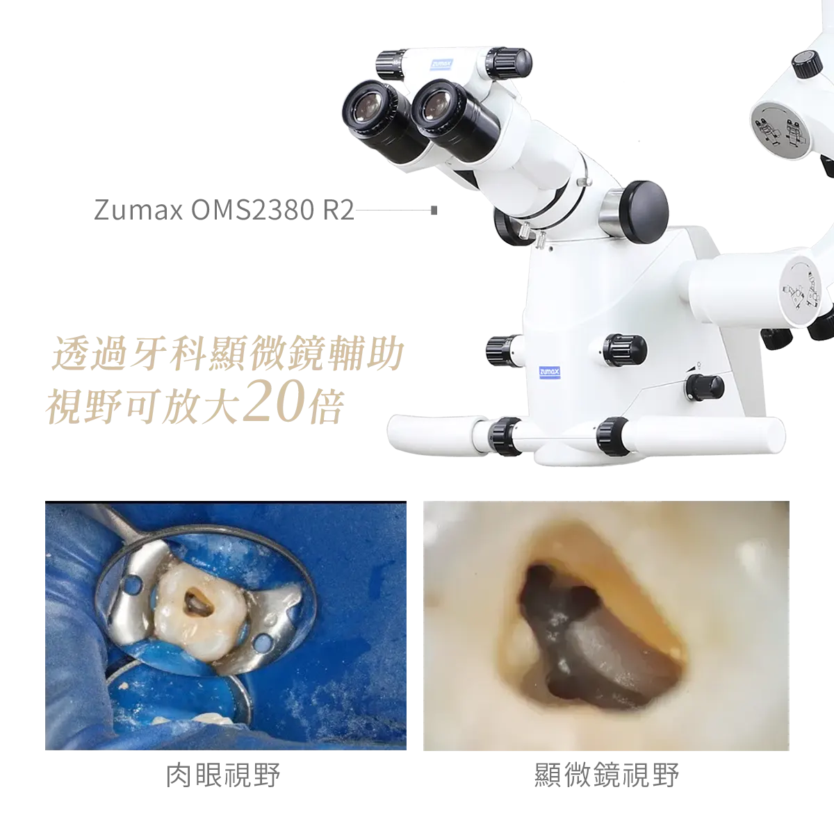 台中南投生活牙醫生活牙醫顯微根管放大根管視野與清創治療示意