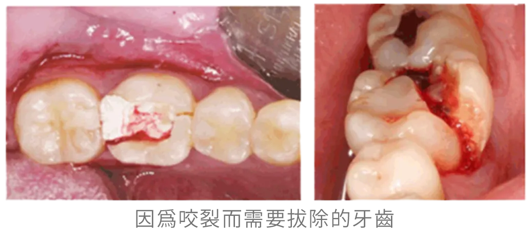 台中南投生活牙醫根管治療後牙齒修復示意圖