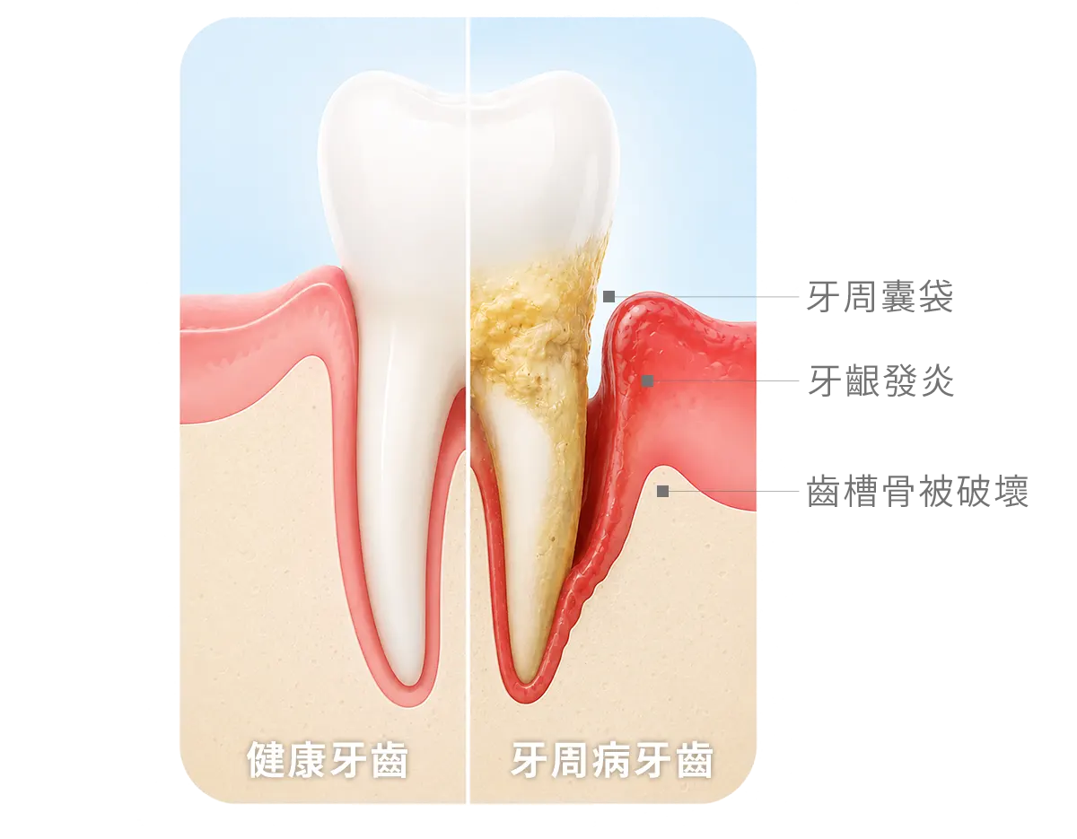 台中南投生活牙醫生活牙醫牙周治療清除牙菌斑與牙結石示意