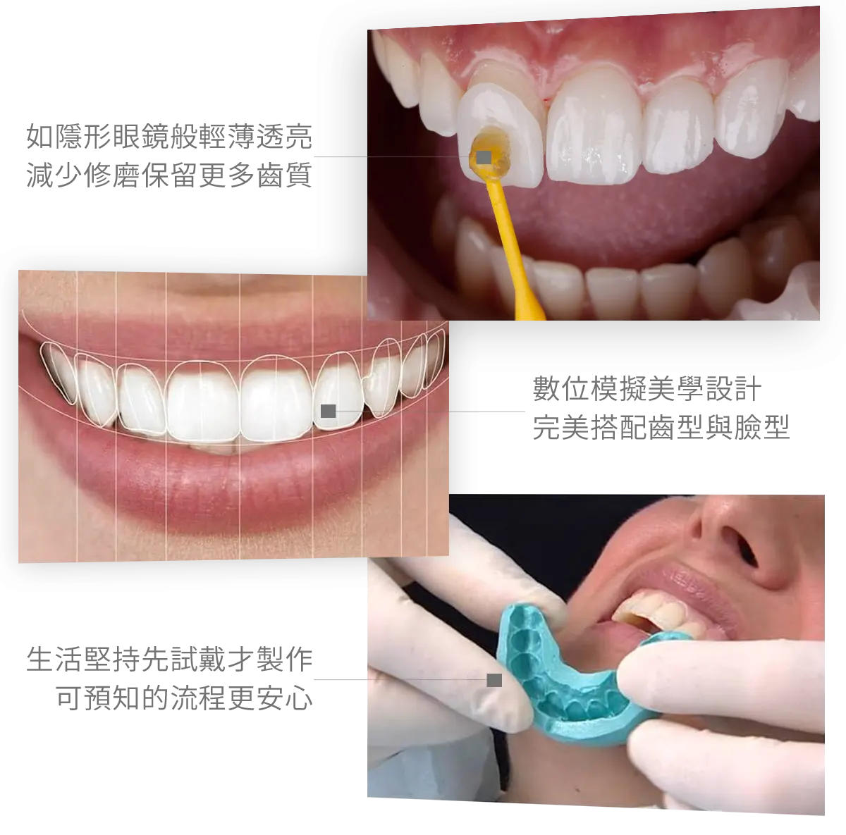 台中南投生活牙醫生活牙醫陶瓷貼片改善齒色與牙齒外型案例
