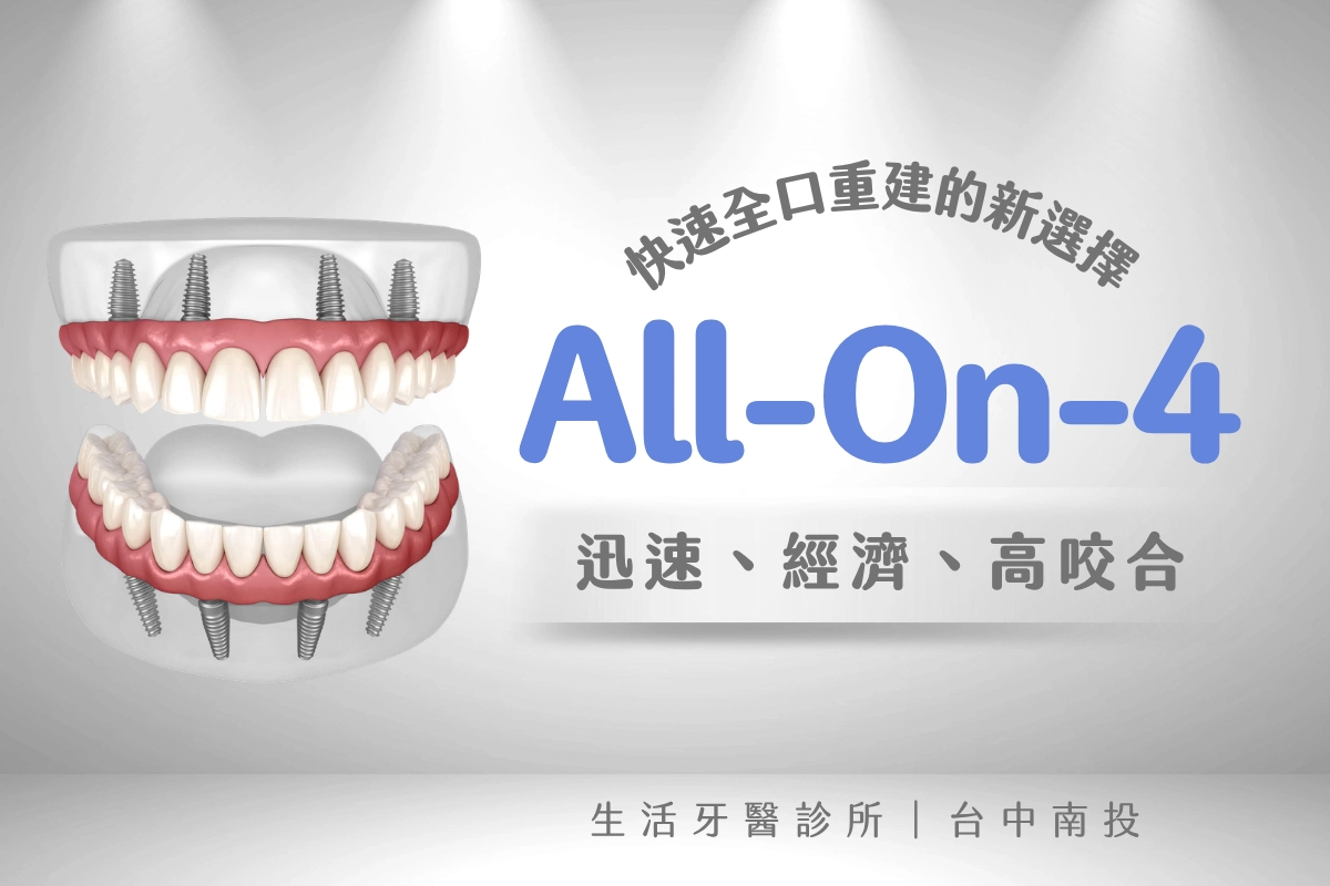 快速全口重建的新選擇「All-On-4」迅速、經濟、好咬