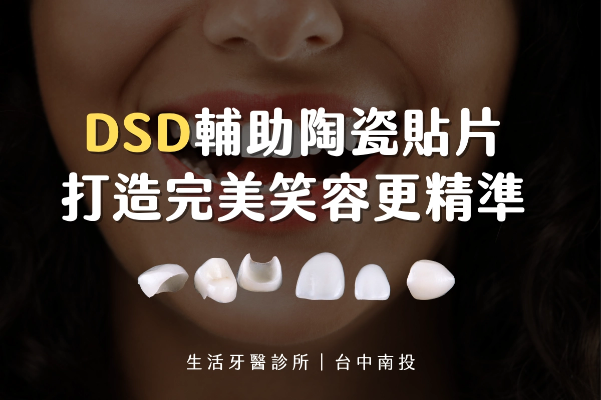 DSD技術輔助陶瓷貼片 打造完美笑容更精準