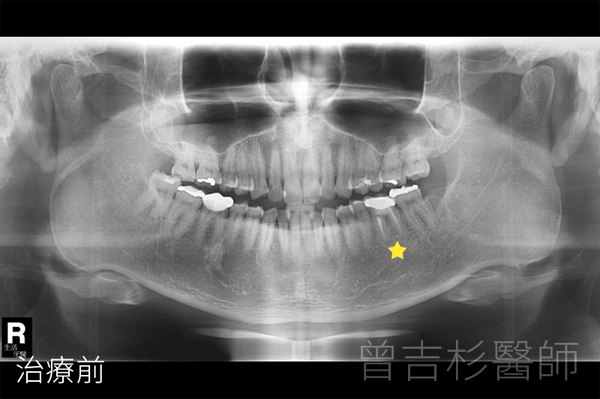 台中全瓷冠+台中陶瓷貼片