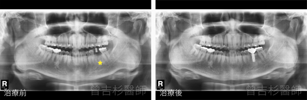 推薦台中植牙牙醫