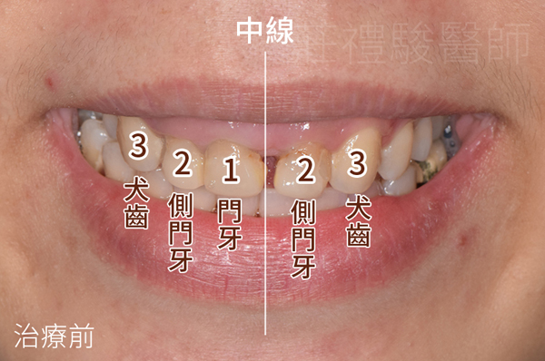台中全瓷牙冠推薦+台中牙齦美容術