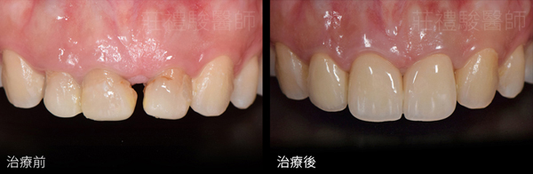 台中 全瓷牙冠 前牙三顆 + 牙齦美容術 實際案例