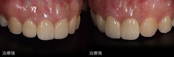 台中 全瓷牙冠 前牙三顆 + 牙齦美容術 實際案例
