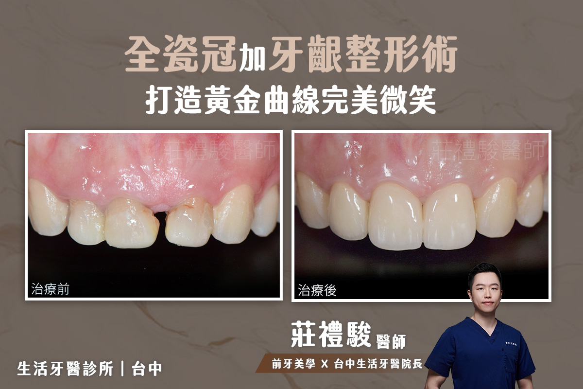 台中 全瓷牙冠 前牙三顆 + 牙齦美容術  實際案例