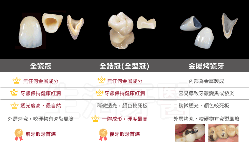 台中全鋯冠 台中全鋯冠價格 台中牙醫推薦 台中假牙推薦