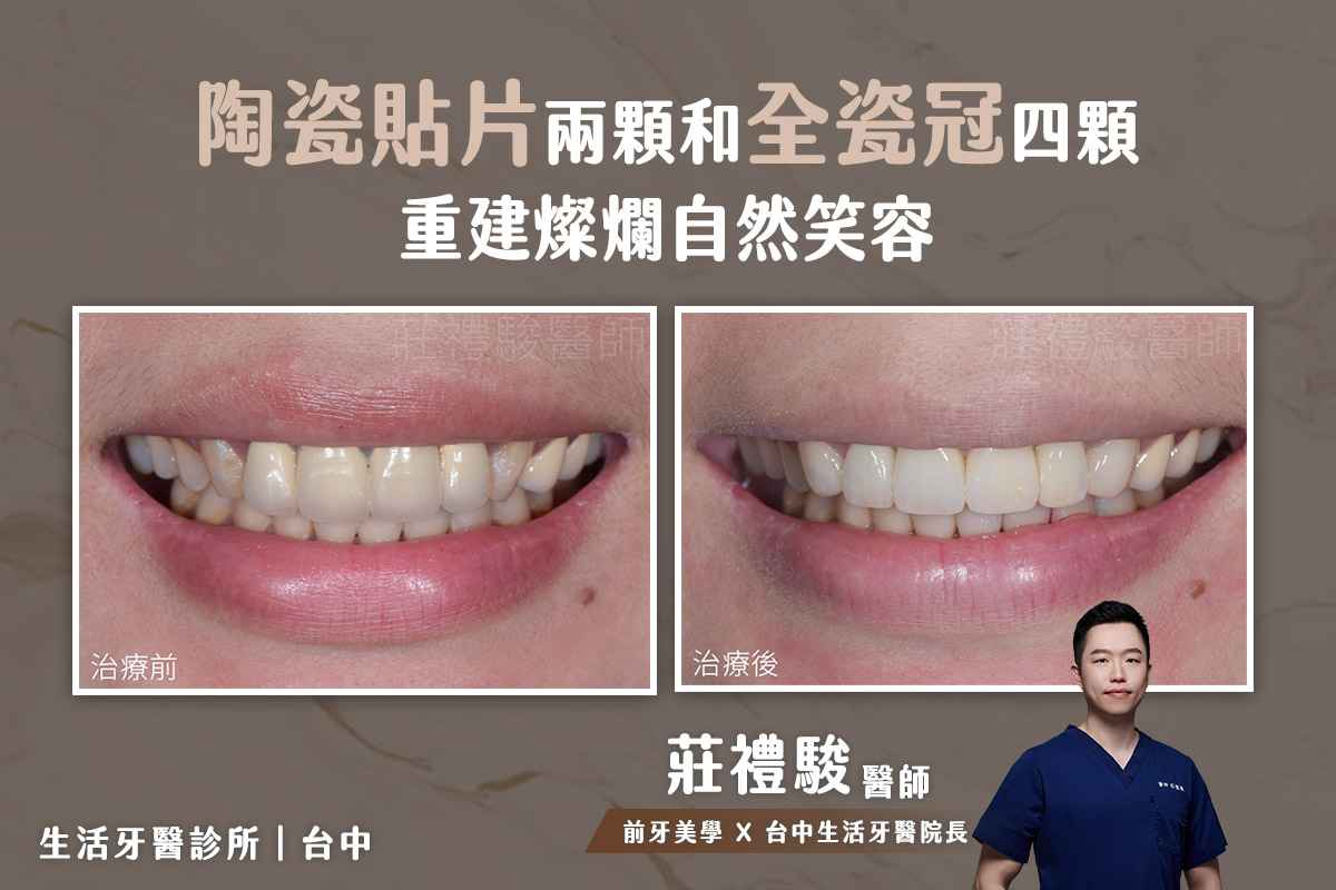 台中陶瓷貼片,全瓷貼片,全瓷牙冠-全瓷貼片兩顆和全瓷冠四顆 前牙美學 美觀重建實際案例