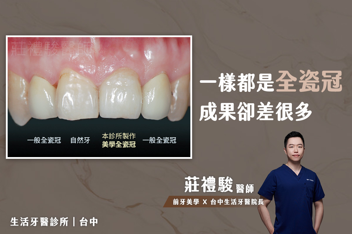 台中全瓷冠| 一樣都是全瓷冠，成果卻差很多