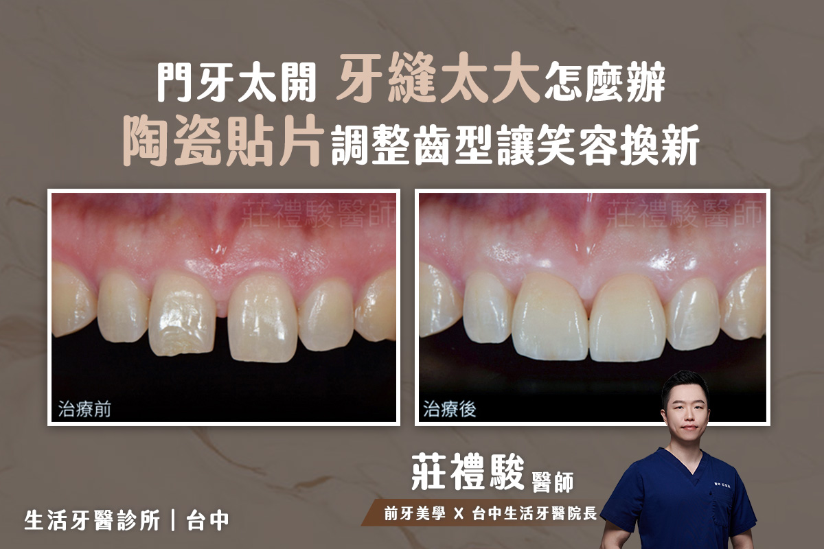 台中陶瓷貼片,全瓷貼片-門牙太開 牙縫太大 美觀重建實際案例