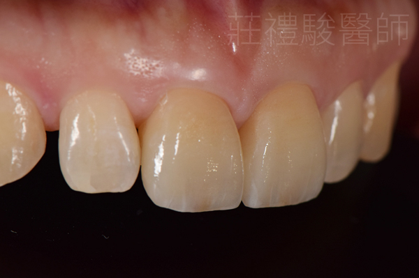 台中陶瓷貼片推薦ptt