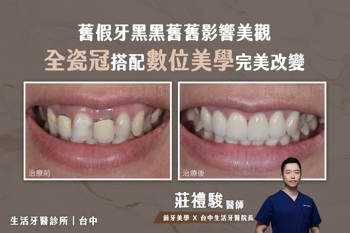 台中全瓷冠推薦 - 四顆門牙全瓷冠 前牙美學實際案例