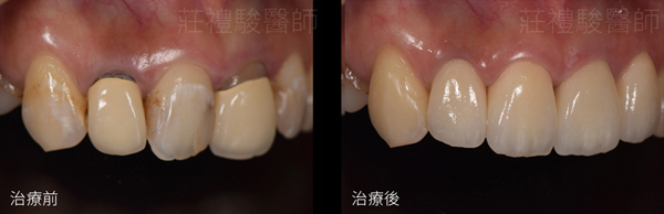 台中全瓷貼片前牙美學