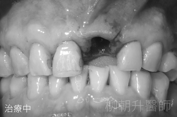 台中陶瓷貼片+門牙開+牙縫太大