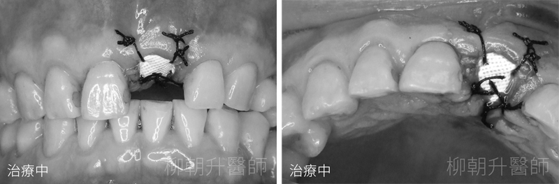 台中全瓷貼片+台中陶瓷貼片