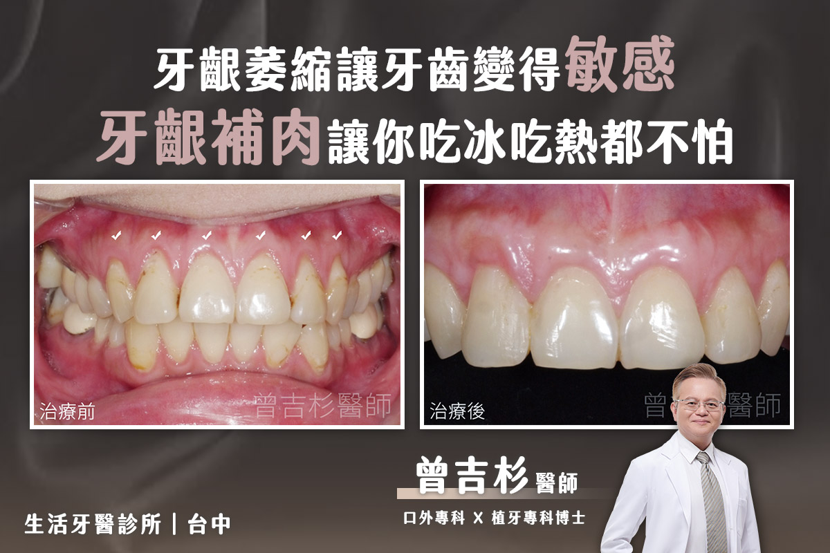 推薦台中牙醫-牙齦萎縮.牙齒敏感 治療-前牙牙齦補肉手術 實際案例分享
