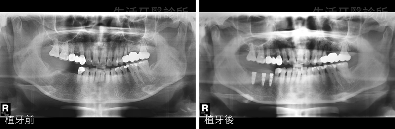 台中植牙專科醫師推薦-臼齒植牙三顆+補骨手術實際案例分享