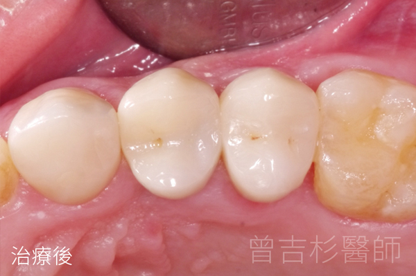 植牙取代假牙牙橋植牙實際案例分享@台中生活牙醫